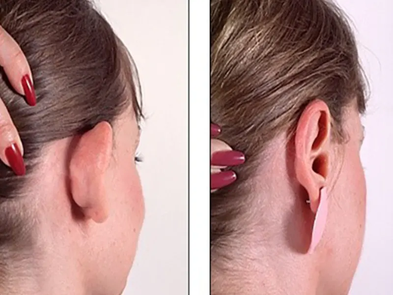 اصلاح فرم گوش در ایران (اتوپلاستی